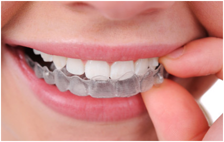 dental implants india